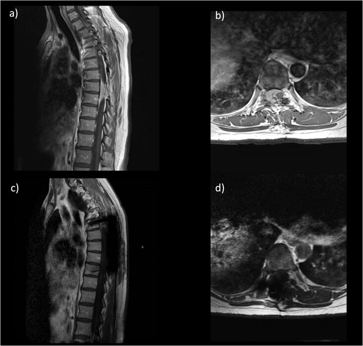Patient-specific automated cerebrospinal fluid pressure control to augment spinal wound closure: a case series using the LiquoGuard®.