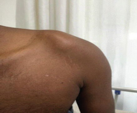 A Case Report of a Rare Entity - Lateral End of Clavicle Chondromyxoid Fibroma which was Mistaken as Giant Cell Tumor and Aneurysmal Cyst.