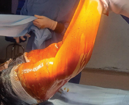 Bilateral Chronic Anterior Cruciate Ligament Tear or Congenital Absence of Anterior Cruciate Ligament? - A Case Report.