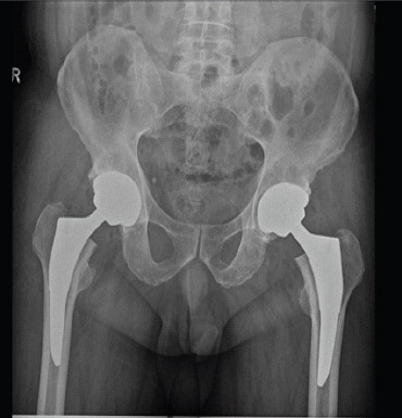 Unexplained Pseudotumor Formation in Ceramic-on-ceramic Hip Bearings: A Case Report.