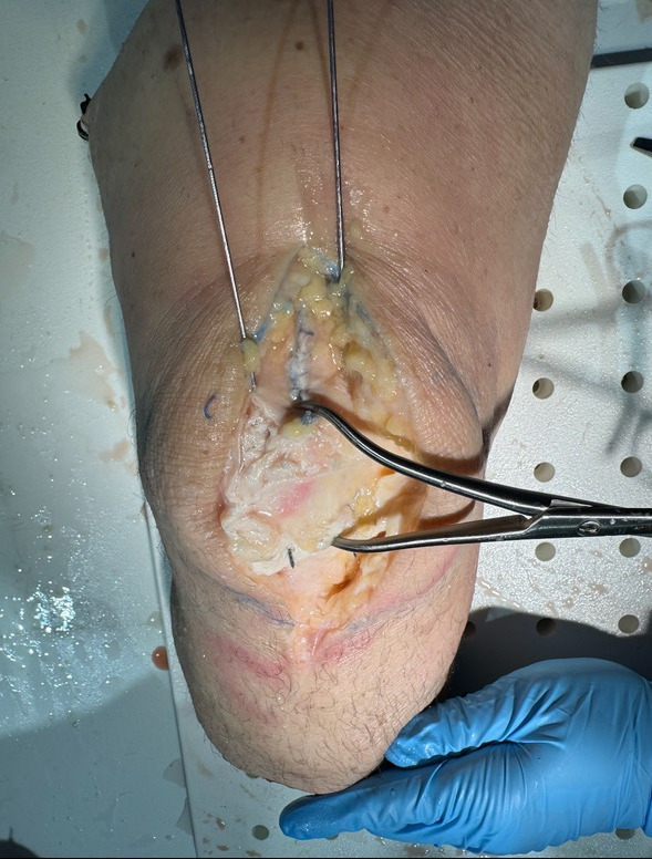 Suture Button with Tension Band Fixation for Patella fractures: A Retrospective Case Series.