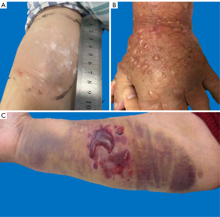 Incidence, outcome, and risk factors of contrast media extravasation injury during contrast-enhanced computed tomography scans: an observational cohort study.