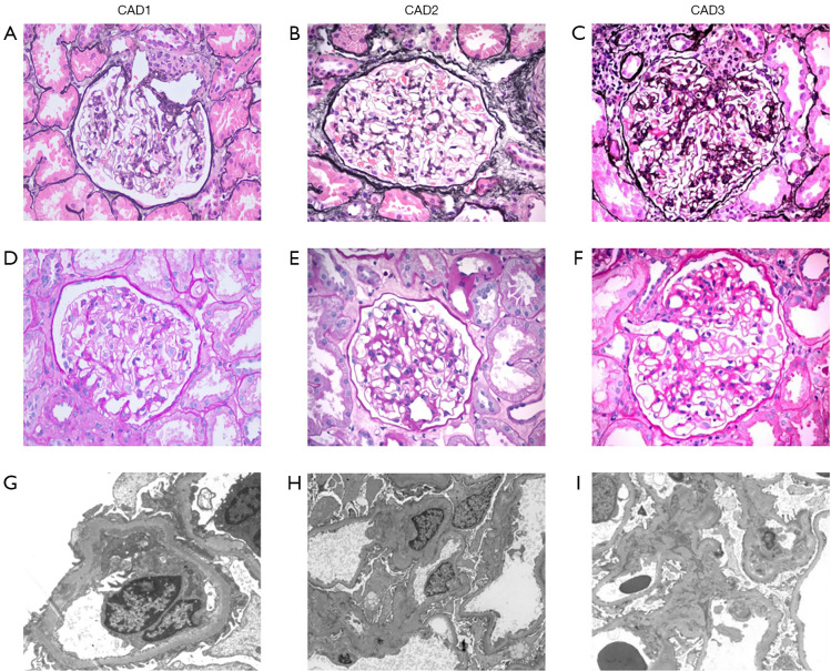 Prospective evaluation of arterial spin labeling and diffusion tensor imaging-magnetic resonance imaging for the non-invasive assessment of renal allograft dysfunction.