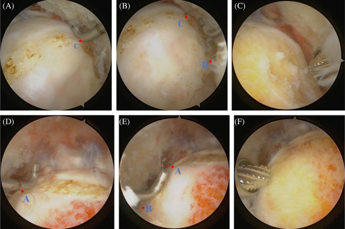Quantitative Evaluation and Preoperative Planning Using Three-Dimensional CT Profiles Improves the Accuracy of Bony Correction Under Primary Hip Arthroscopy and Clinical Outcomes in the Setting of Cam-Type Femoroacetabular Impingement Syndrome.