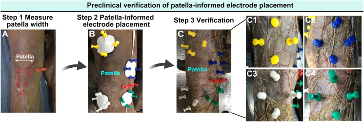 Electrode Placement Affects Clinical Outcome in Transcutaneous Electrical Nerve Stimulation for Knee Osteoarthritis: A Combined Cadaver Study and Randomized Controlled Trial.