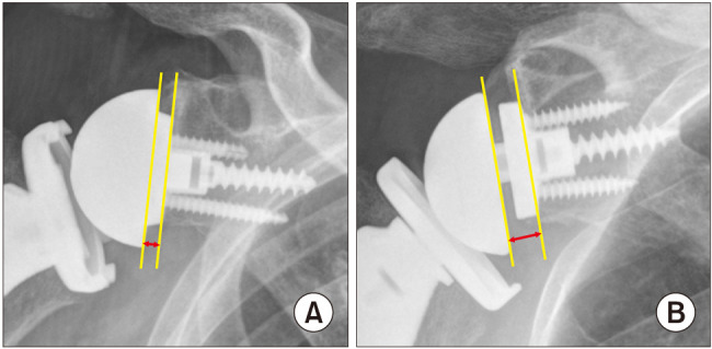 Clinical and Radiological Comparison between Asian-Type and Conventional Reverse Shoulder Arthroplasty: A Multicenter Randomized Controlled Trial.