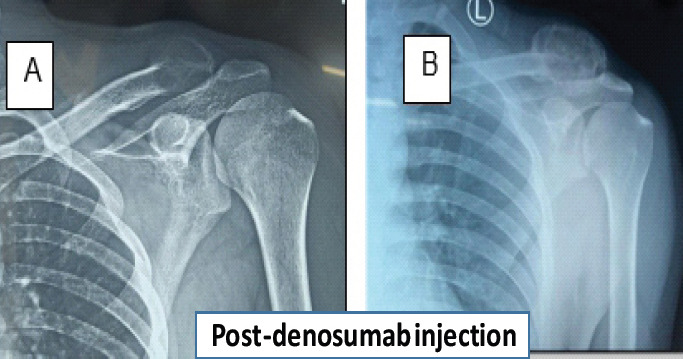 A Case Report of a Rare Entity - Lateral End of Clavicle Chondromyxoid Fibroma which was Mistaken as Giant Cell Tumor and Aneurysmal Cyst.