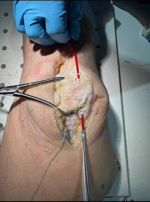 Suture Button with Tension Band Fixation for Patella fractures: A Retrospective Case Series.