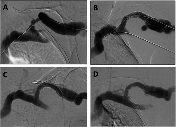 Patency rates following treatment with the WRAPSODY™ Cell-Impermeable Endoprosthesis for recalcitrant renal access circuit dysfunction: Results from a tertiary Australian centre.