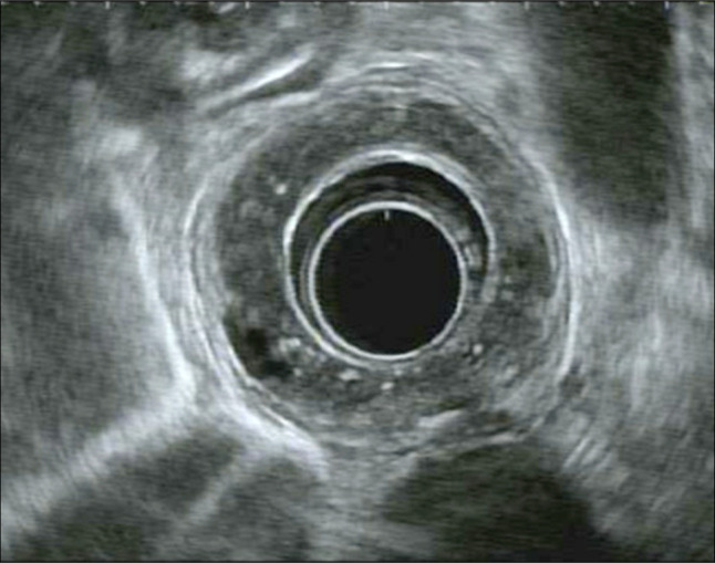 Multifocal Superficial Squamous Cell Carcinoma Arising in the Setting of Esophageal Intramural Pseudodiverticulosis.