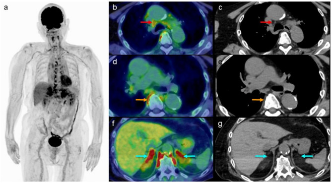 Effect of β3-adrenergic receptor agonists on [<sup>18</sup>F] fluorodeoxyglucose uptake in brown adipose tissues in positron emission tomography images of elderly patients.