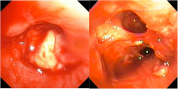 Successful Allogeneic Stem Cell Transplant for Philadelphia Chromosome Negative Acute Lymphoblastic Leukemia After Pneumonectomy for Pulmonary Mucormycosis: A Case Report and Review of the Literature.