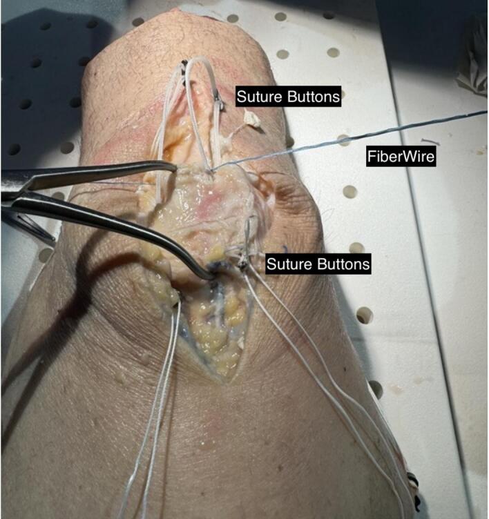 Suture Button with Tension Band Fixation for Patella fractures: A Retrospective Case Series.