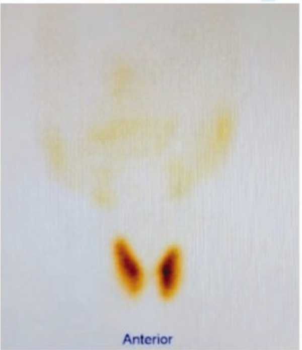 Sheehan's syndrome complicated with Graves' disease in a woman with a 20-year history of hypothyroidism.