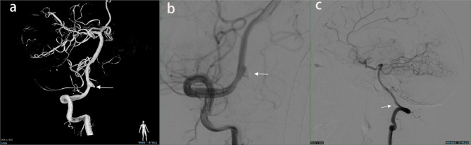 Ruptured intracranial aneurysm with spontaneous occlusion of internal carotid artery: clinical characteristics, prognostic risk factors, and survival analysis.