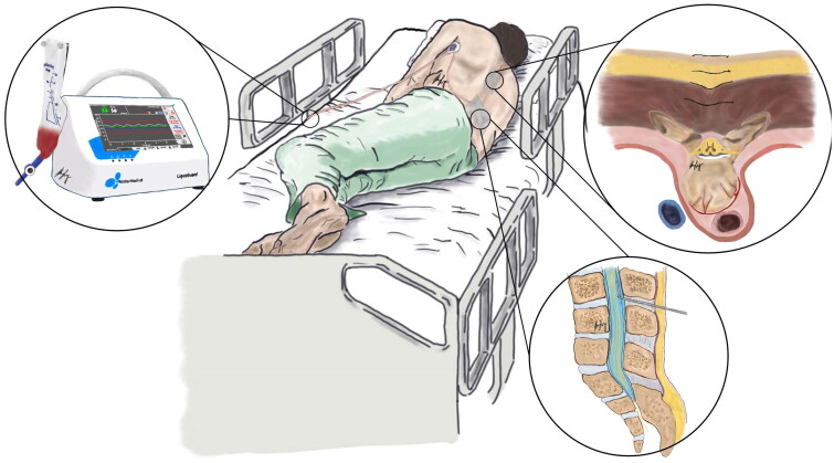 Patient-specific automated cerebrospinal fluid pressure control to augment spinal wound closure: a case series using the LiquoGuard®.