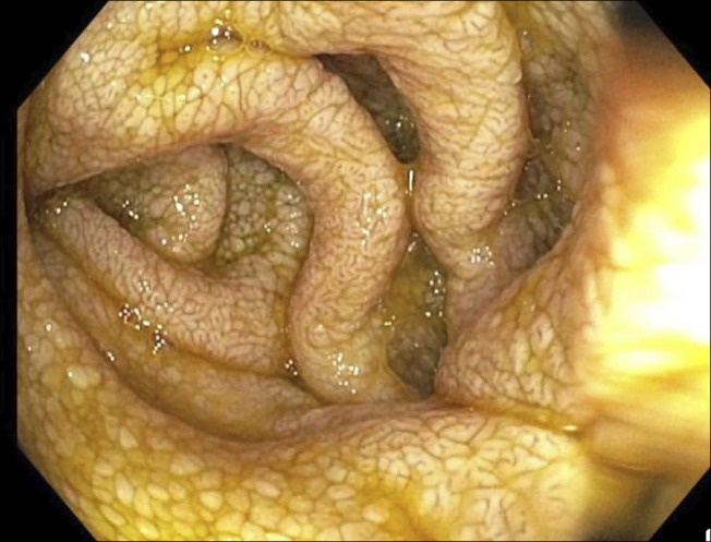 An Extremely Rare Cause of Protein-Losing Enteropathy: Waldenström Macroglobulinemia.