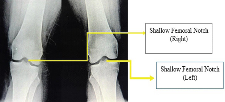 Bilateral Chronic Anterior Cruciate Ligament Tear or Congenital Absence of Anterior Cruciate Ligament? - A Case Report.