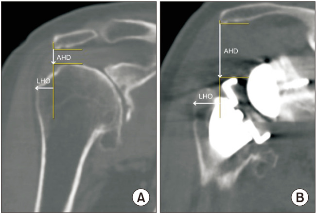 The Impact of Critical Shoulder Angle during Reverse Total Shoulder Arthroplasty: Is It Helpful?