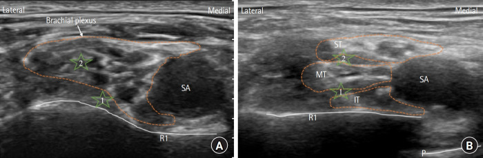 Intertruncal versus classical approach to supraclavicular brachial plexus block on sensory-motor blockade for upper extremity surgery: a randomized controlled non-inferiority trial.