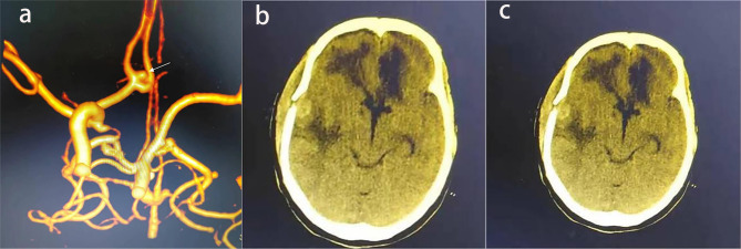 Ruptured intracranial aneurysm with spontaneous occlusion of internal carotid artery: clinical characteristics, prognostic risk factors, and survival analysis.