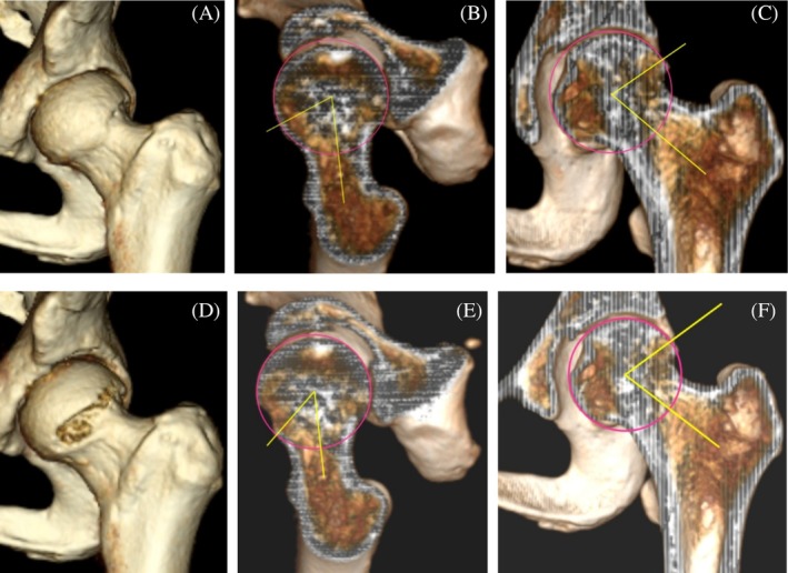 Quantitative Evaluation and Preoperative Planning Using Three-Dimensional CT Profiles Improves the Accuracy of Bony Correction Under Primary Hip Arthroscopy and Clinical Outcomes in the Setting of Cam-Type Femoroacetabular Impingement Syndrome.