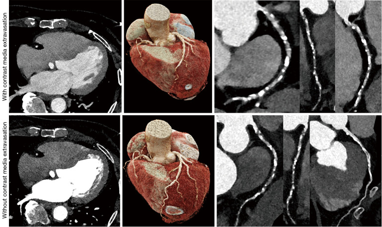 Incidence, outcome, and risk factors of contrast media extravasation injury during contrast-enhanced computed tomography scans: an observational cohort study.