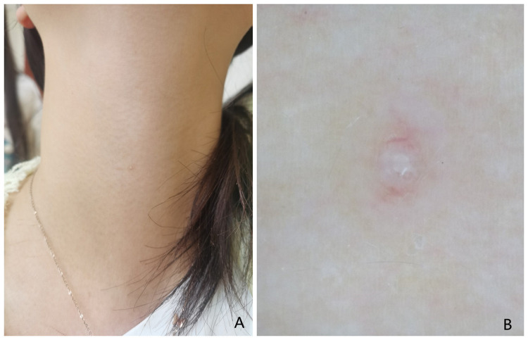 Meyerson's Phenomenon Induced by Molluscum Contagiosum in an Adult: A Rare Case Report.