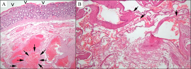 Isolated Colorectal Involvement in Klippel-Trenaunay Syndrome: A Case of Extensive Vascular Malformation.
