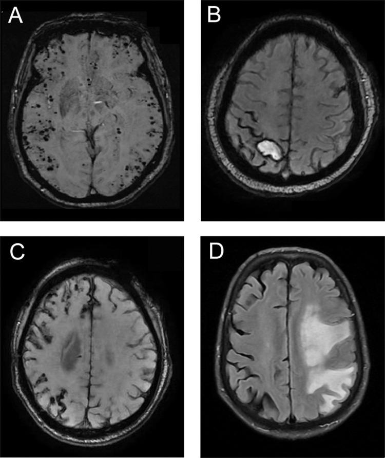 Cerebral Amyloid Angiopathy-Related Inflammation: Clinical Characteristics and Treatment Experience.