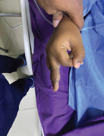Don't Dismiss the Swelling: A Rare Case of Tenosynovial Giant Cell Tumor in a Young Woman's Finger - A Case Report.