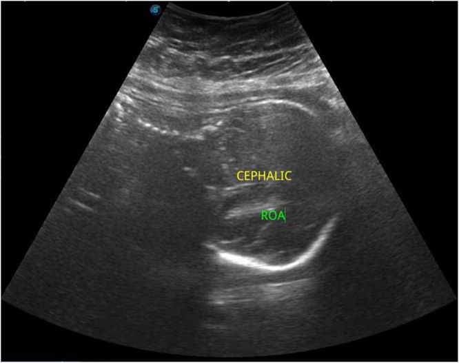 Conservative Treatment of Third Trimester Appendicitis Misdiagnosed as Round Ligament Pain. A Case Report and Review of the Literature in a Resource-Limited Setting.