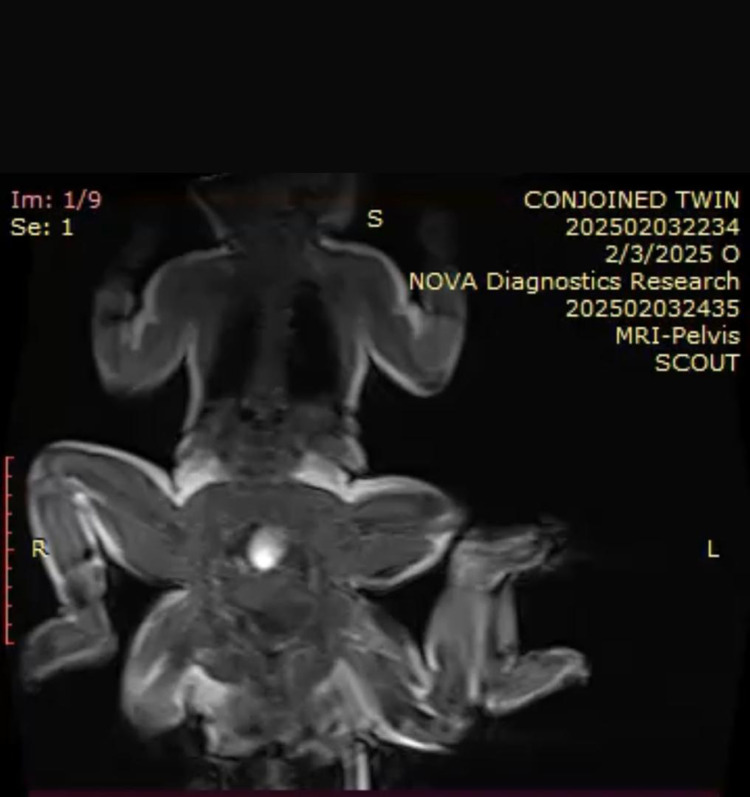 Ischiopagus Conjoint Twins: A Case Report.