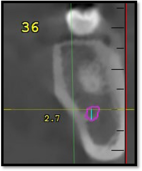 Assessment of the submandibular fossa depth and diameter of the mandibular canal via cone beam computed tomography: a comparative study.