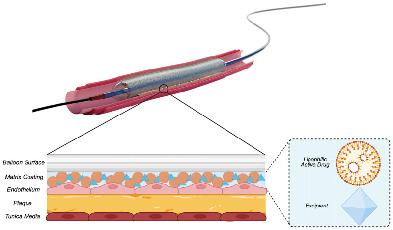 Drug-Coated Balloons for Coronary Interventions: A Focused Review.