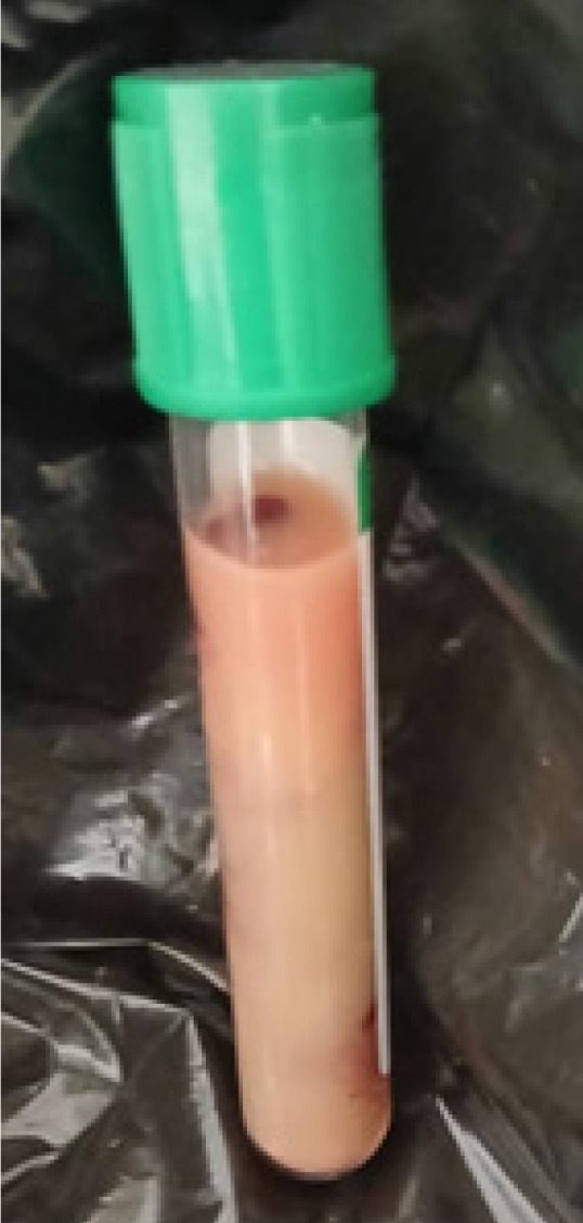 Convergence of diabetic ketoacidosis, acute pancreatitis, and malaria: A case report.