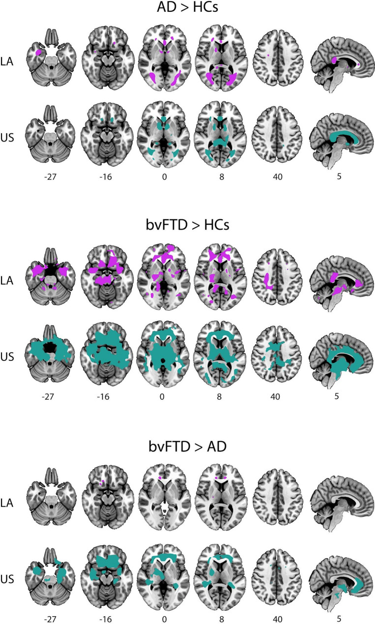 White matter hyperintensities and their impact in brain structure and function in alzheimer's disease and behavioral variant frontotemporal dementia across Latin America and the United States: a cross-sectional study.