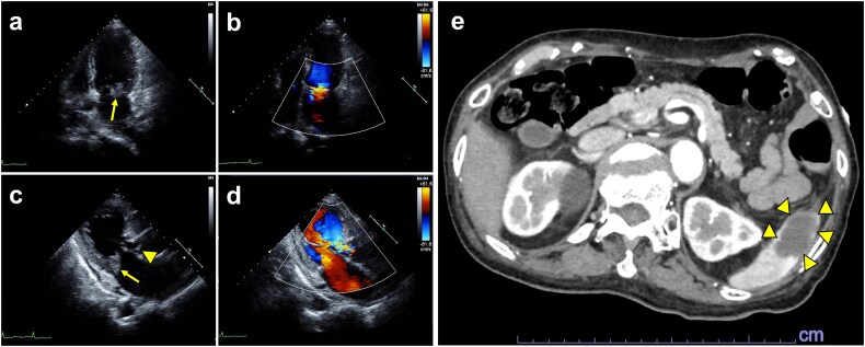 Successful fluoroquinolone-based salvage therapy in the conservative management of refractory infective endocarditis caused by <i>Streptococcus anginosus</i> in an elderly patient: a case report.