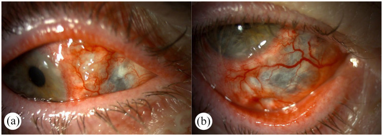 Clinical spectrum and management of anterior scleritis: case reports.