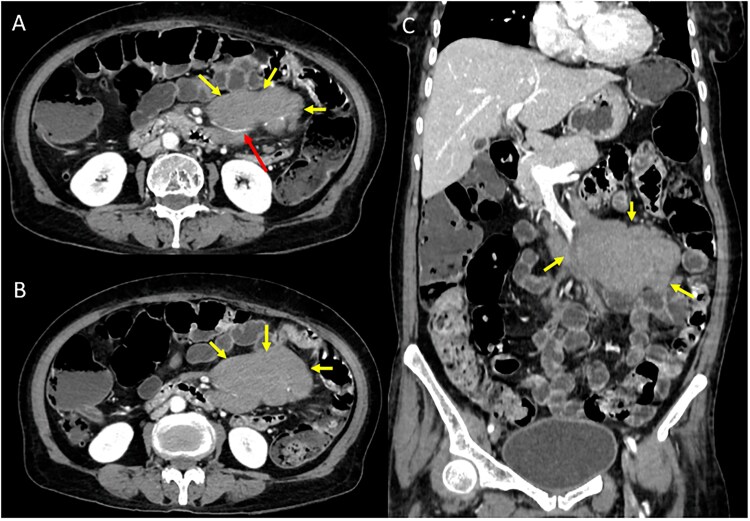 From oral erosions to lymphoma: a case of paraneoplastic pemphigus with occult lymphoma.