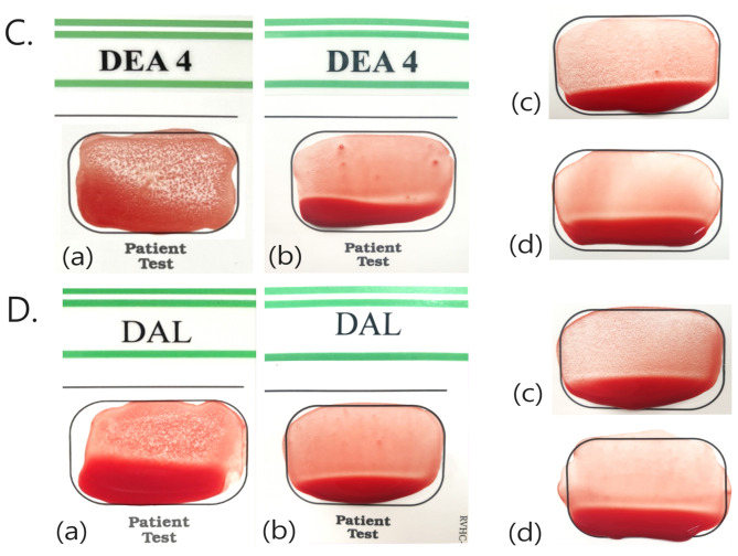 Prevalence of Dal blood type and dog erythrocyte antigens 1 and 4 among canine blood donors and recipients in Seoul, South Korea.
