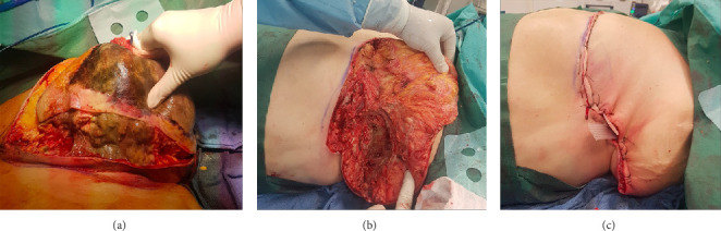 Bacterial Synergism in Breast Necrotizing Fasciitis: A Case Report on Diagnostic Dilemmas, Therapeutic Challenges, and Reconstructive Management.