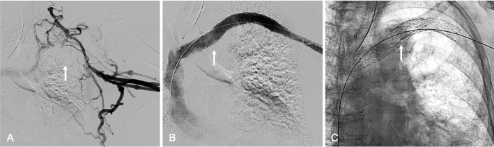Dedicated venous stent placement across the thoracic outlet: will novel venous stents transform axillosubclavian vein thrombosis treatment paradigm?