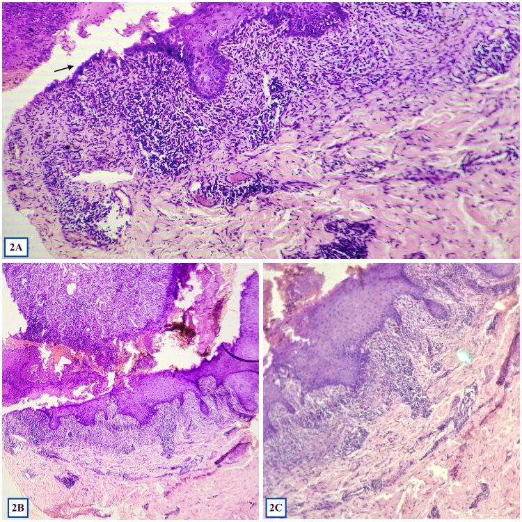 From oral erosions to lymphoma: a case of paraneoplastic pemphigus with occult lymphoma.