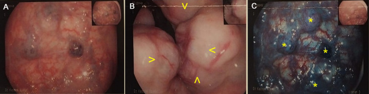 Isolated Colorectal Involvement in Klippel-Trenaunay Syndrome: A Case of Extensive Vascular Malformation.