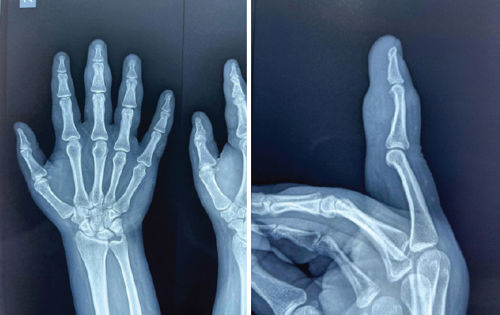 Don't Dismiss the Swelling: A Rare Case of Tenosynovial Giant Cell Tumor in a Young Woman's Finger - A Case Report.