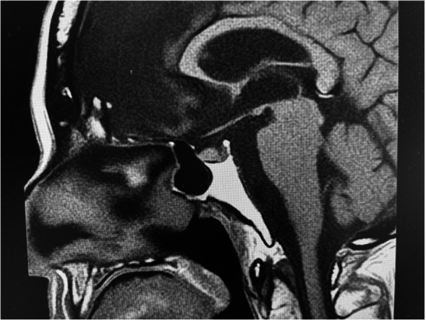 Partial central diabetes insipidus during lithium use: A case report and literature review.
