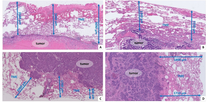Integrating peritumor and tumor CT radiomics features in predicting local control after SBRT in patients with pulmonary oligometastases.