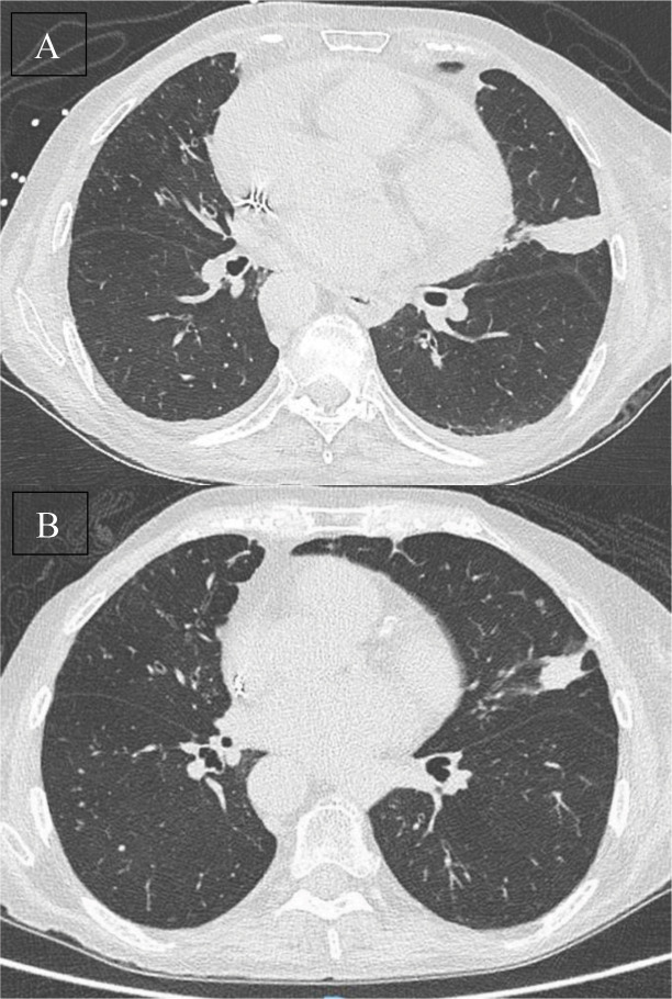 Microwave Ablation of Pulmonary Carcinoid Tumor: A Therapeutic Alternative for Inoperable Cases.