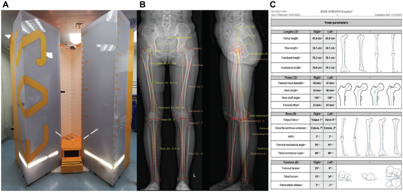 Reliability and Reproducibility of the EOS 3D Imaging System in Measuring TT-TG Distance in Patients With Recurrent Patellar Dislocation.